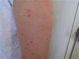photos of Treatment Of Bed Bug Bites photos of Treatment Of Bed Bug Bites
