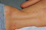 How To Treat Bed Bugs Bites pictures How To Treat Bed Bugs Bites pictures