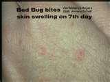 How To Treat Bed Bugs Bites pictures How To Treat Bed Bugs Bites pictures