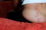 photos of Bed Bugs Exterminators