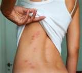 Bed Bugs Treatment On Skin pictures