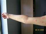 images of Bed Bug Exterminator Cost