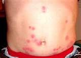 Treatment Of Bed Bug Bites images Treatment Of Bed Bug Bites images