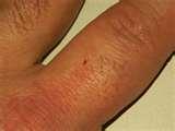 photos of Insecticide For Bed Bugs
