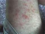 Bed Bugs Rash images