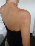 Insecticides For Bed Bugs pictures