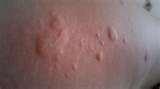 Bed Bugs Info photos