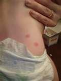 Bed Bugs Rash