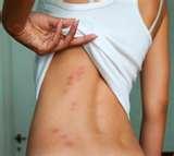 Bed Bugs Rash images