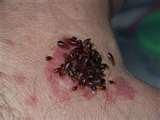 What Is Bed Bugs pictures