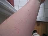 photos of Bed Bugs Rash