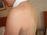Insecticide For Bed Bugs photos