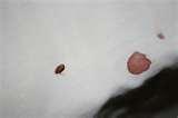 photos of Steamer Bed Bugs