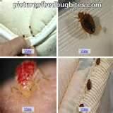 Bed Bug Bites Treatment
