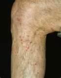 How To Stop Bed Bugs pictures