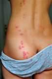 Different Types Of Bed Bugs photos