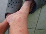 photos of How To Spot Bed Bugs