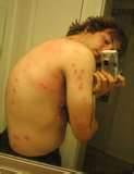 photos of Exterminator Bed Bugs
