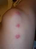 photos of Different Types Of Bed Bugs