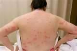 How To Rid Bed Bugs images