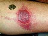 How To Spot Bed Bugs pictures
