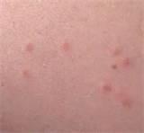 images of Bed Bug Remedy