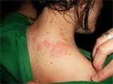 images of Bed Bugs Treatment At Home
