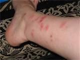 How Get Rid Of Bed Bugs photos