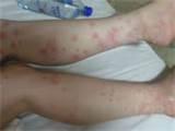 How Get Rid Of Bed Bugs images
