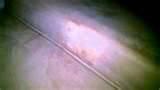 Heat Treatment For Bed Bugs images
