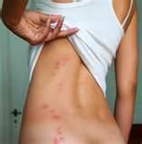images of Remedies For Bed Bugs
