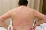 Bed Bug Remedy pictures