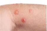 pictures of Removing Bed Bugs