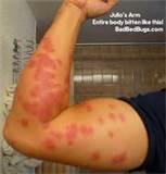 How To Eliminate Bed Bugs images