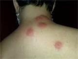 Images of Bed Bug Bite Images