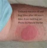 Pictures of Bed Bug Bite Images