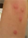 Images of Bed Bug Bites Pics