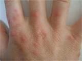 Bed Bug Bites Pics