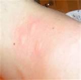 Bed Bug Bites Pics Images
