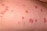 Bed Bug Bite Images Images