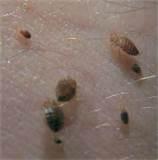Hotel Bed Bugs Photos