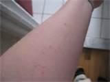 Photos of Bed Bug Bites Pics