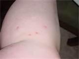 Bed Bug Bite Images Photos