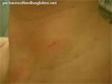 Images of Bed Bug Bite Images