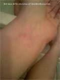 Pics Of Bed Bug Bites Pictures
