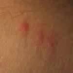 Bed Bug Bite Images Images