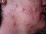 Images of Bed Bug Bite Pictures On Humans