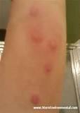 Pictures of Images Of Bed Bug Bites