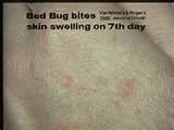 Images of Bed Bug Bite Pictures On Humans