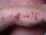 Pictures of Bed Bug Picture Pictures of Bed Bug Picture